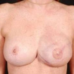 Reconstructive Breast Revision - Case #9 After