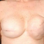Reconstructive Breast Revision - Case #10 Before