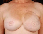 Reconstructive Breast Revision - Case #10 After