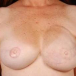 Reconstructive Breast Revision - Case #10 After