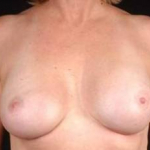 Reconstructive Breast Revision - Case #11 After