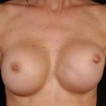 Reconstructive Breast Revision - Case #12 Before