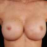 Reconstructive Breast Revision - Case #12 After