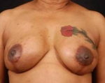 Reconstructive Breast Revision - Case #13 After