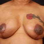 Reconstructive Breast Revision - Case #13 After