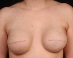 Reconstructive Breast Revision - Case #14 Before