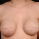 Reconstructive Breast Revision - Case #14 Before