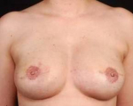 Reconstructive Breast Revision - Case #14 After