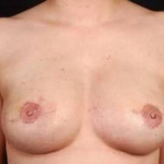 Reconstructive Breast Revision - Case #14 After