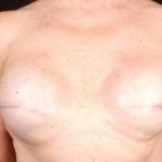 Reconstructive Breast Revision - Case #15 Before
