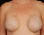 Reconstructive Breast Revision - Case #16 Before