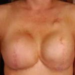 Reconstructive Breast Revision - Case #17 Before