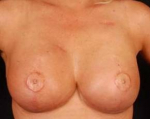Reconstructive Breast Revision - Case #17 After