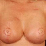 Reconstructive Breast Revision - Case #17 After