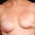 Reconstructive Breast Revision - Case #18 Before