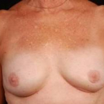 Reconstructive Breast Revision - Case #18 After