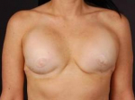Reconstructive Breast Revision - Case #19 Before