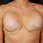 Reconstructive Breast Revision - Case #19 Before