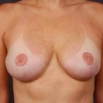 Reconstructive Breast Revision - Case #19 After