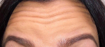 Botox<sup>®</sup> Case 1 Before