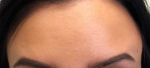 Botox<sup>®</sup> Case 1 After