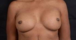 Reconstructive Breast Revision - Case #23 Before