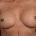 Reconstructive Breast Revision - Case #23 Before