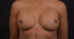 Reconstructive Breast Revision - Case #23 After