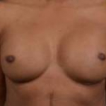 Reconstructive Breast Revision - Case #23 After