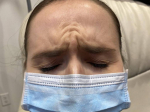 Botox<sup>®</sup> Case 2 Before