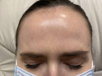 Botox<sup>®</sup> Case 2 After