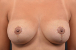Mastopexy - Case #36 After