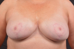 Breast Revision - Case #63 After