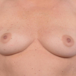 Immediate Breast Reconstruction - Nipple Sparring - Case #50 Before