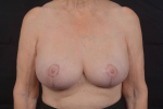 Breast Augmentation Mastopexy Revision - Case #57 After