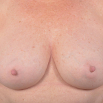 Breast Revision - Case #66 After