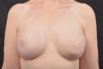 Reconstructive Breast Revision - Case #32 After