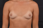 Breast Augmentation Silicone Gel - Case #76 Before