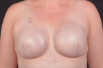 Immediate Breast Reconstruction - Skin Sparring - Case #25 After