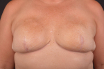 Immediate Breast Reconstruction - Skin Sparring - Case #26 After