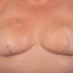 Immediate Breast Reconstruction - Skin Sparring - Case #26 After