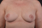 Mastopexy - Case #39 After