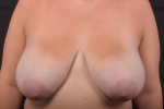 Breast Reduction - Case #36 Before