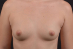 Breast Augmentation Silicone Gel - Case #81 Before