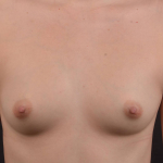 Breast Augmentation Silicone Gel - Case #81 Before