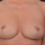 Breast Revision - Case #74 After