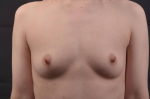 Breast Augmentation Silicone Gel - Case #78 Before