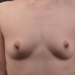Breast Augmentation Silicone Gel - Case #78 Before