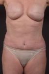 Abdominoplasty - Case #53 After