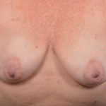 Immediate Breast Reconstruction -  Skin Sparring - Case #46 Before